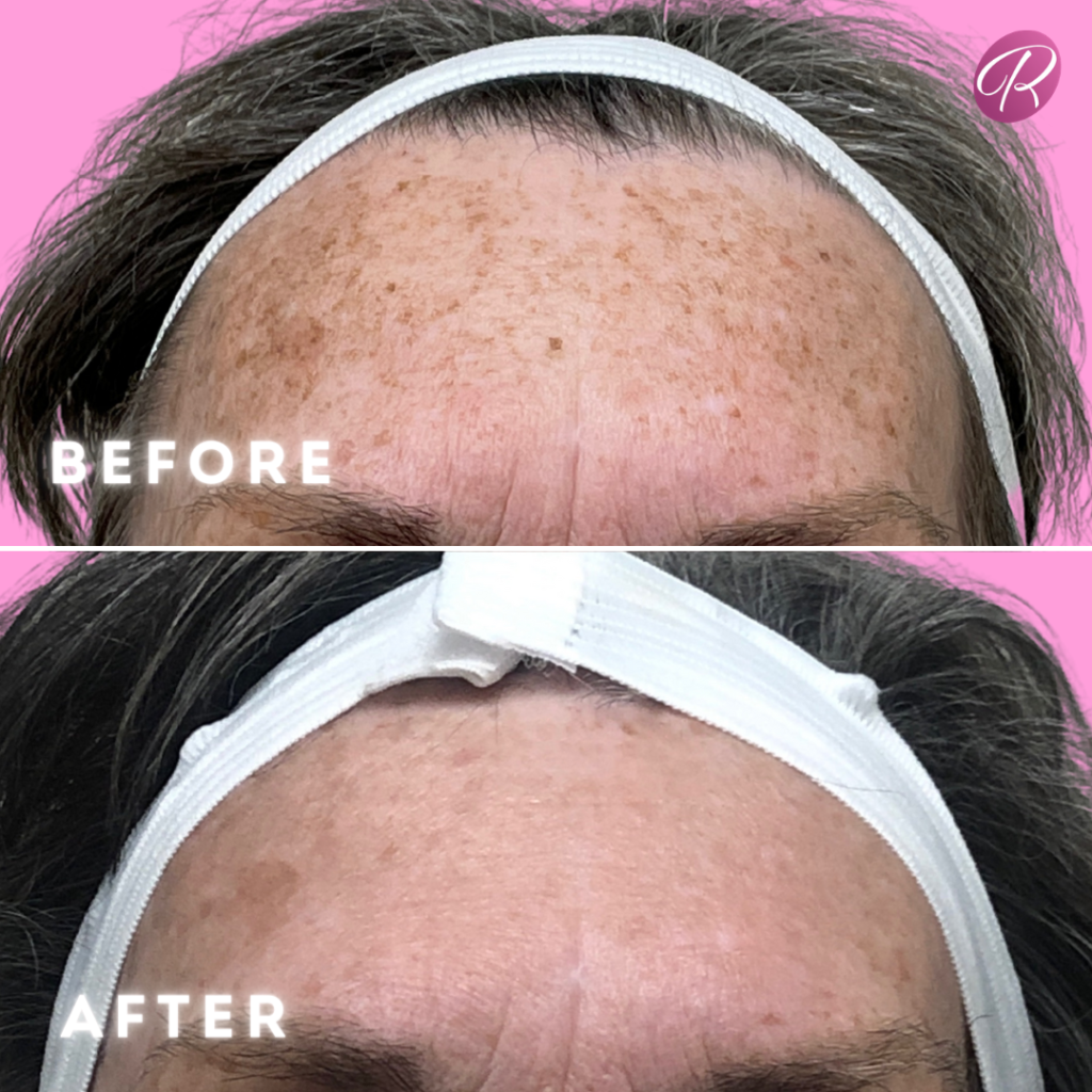 Lumecca Before & After Gallery - Patient 12693 - Image 1