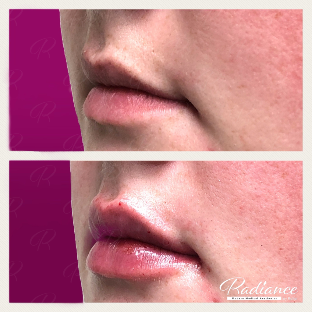 Fillers Before & After Gallery - Patient 12470 - Image 2