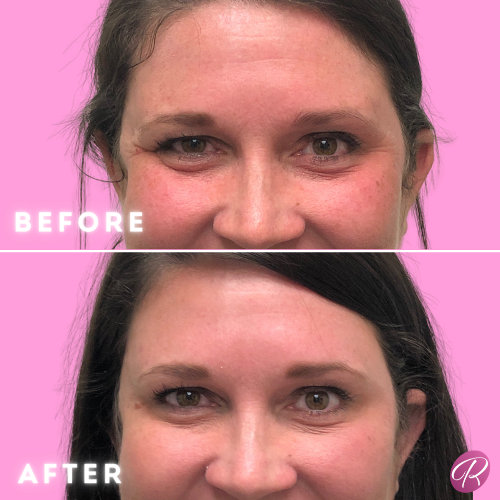 BOTOX Cosmetic Before & After Gallery - Patient 12549 - Image 1