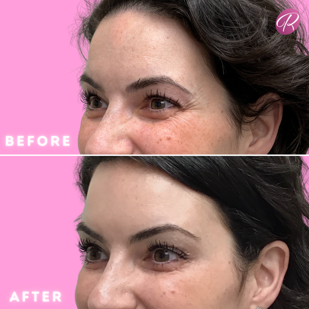 BOTOX Cosmetic Before & After Gallery - Patient 12546 - Image 1