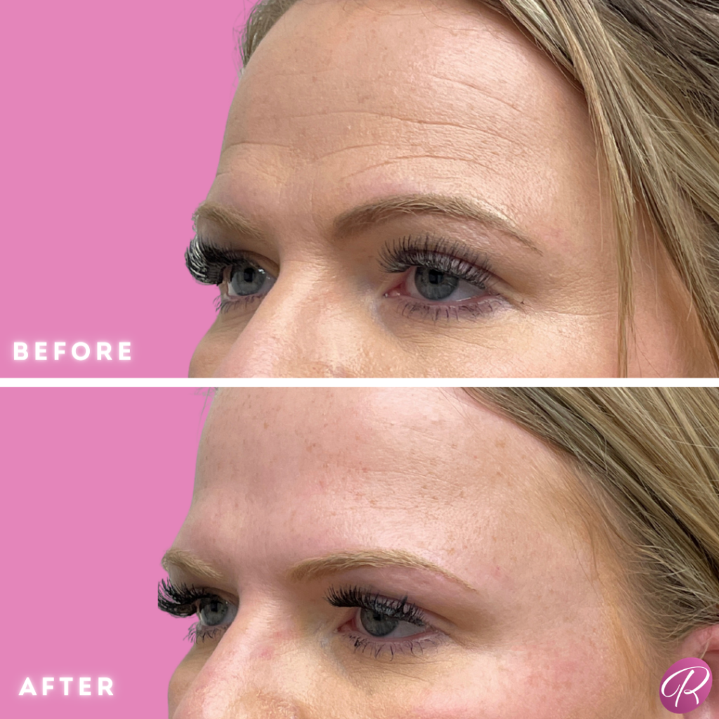 BOTOX Cosmetic Before & After Gallery - Patient 12543 - Image 1