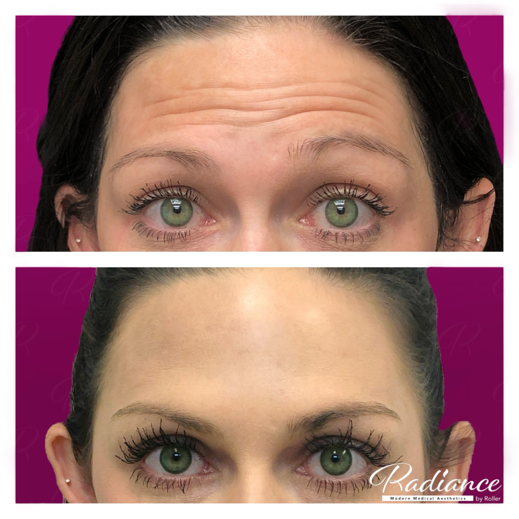 BOTOX Cosmetic Before & After Gallery - Patient 12541 - Image 1