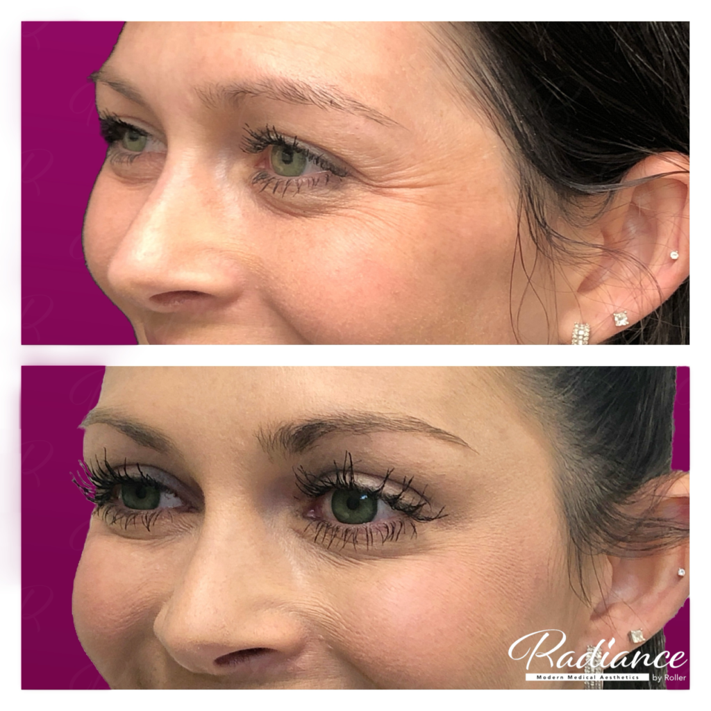 BOTOX Cosmetic Before & After Gallery - Patient 12539 - Image 1