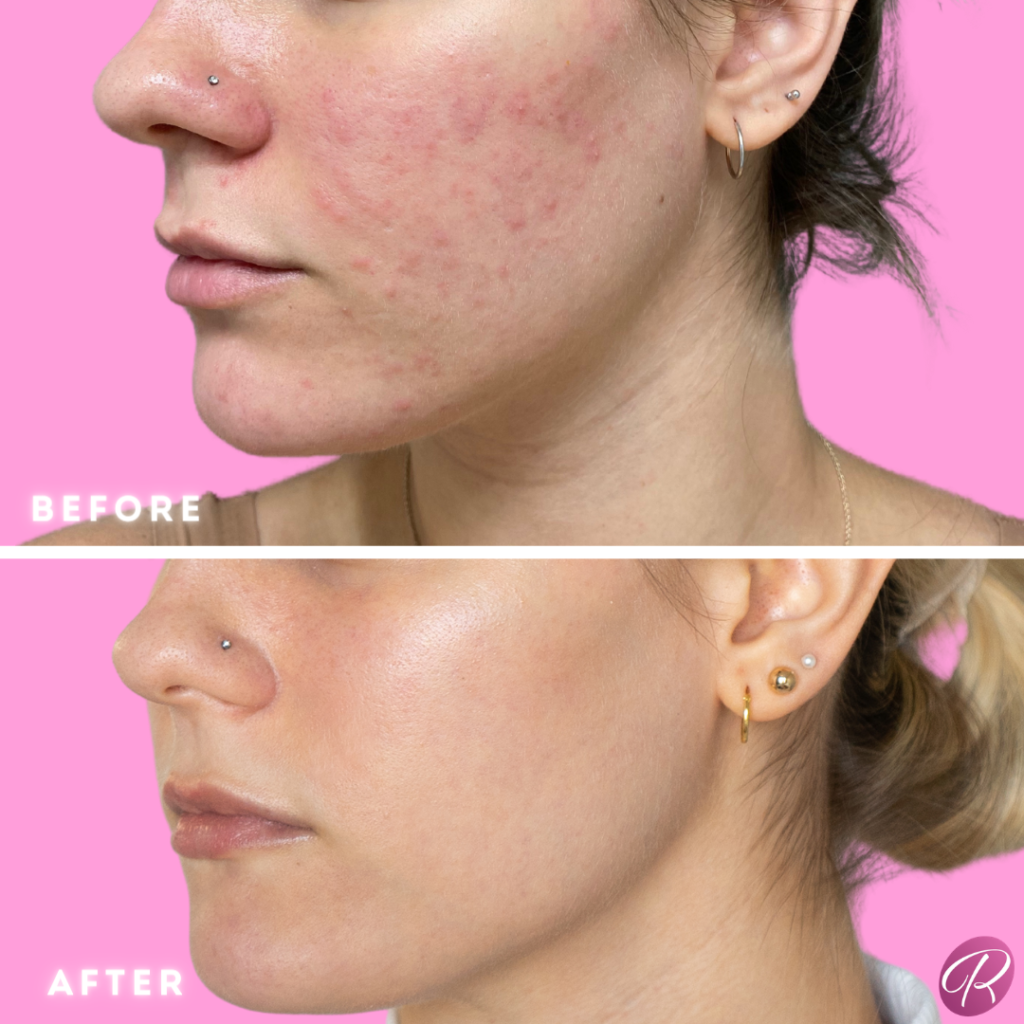 SkinPen Before & After Gallery - Patient 12667 - Image 1