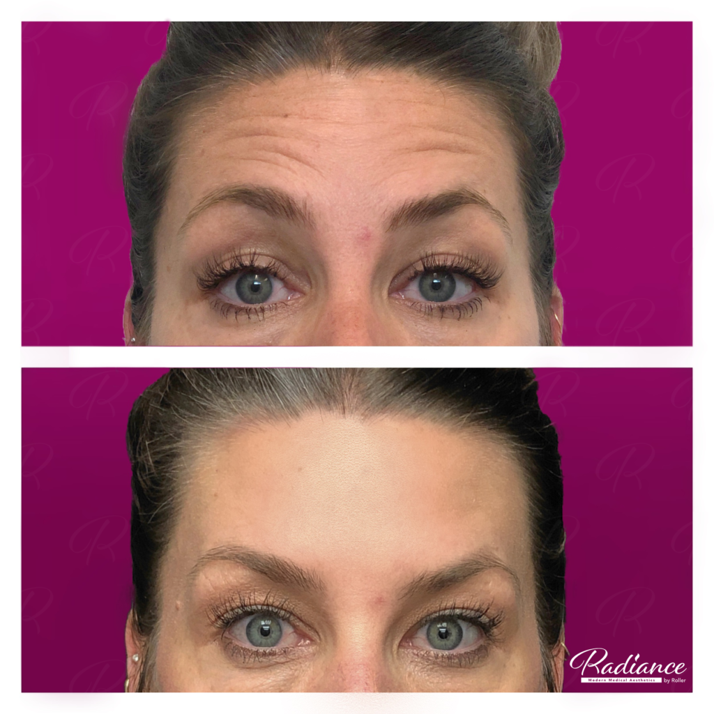 BOTOX Cosmetic Before & After Gallery - Patient 12534 - Image 1