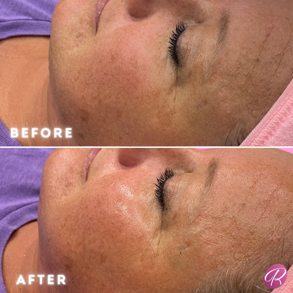 Diamond Glow Before & After Gallery - Patient 12697 - Image 1