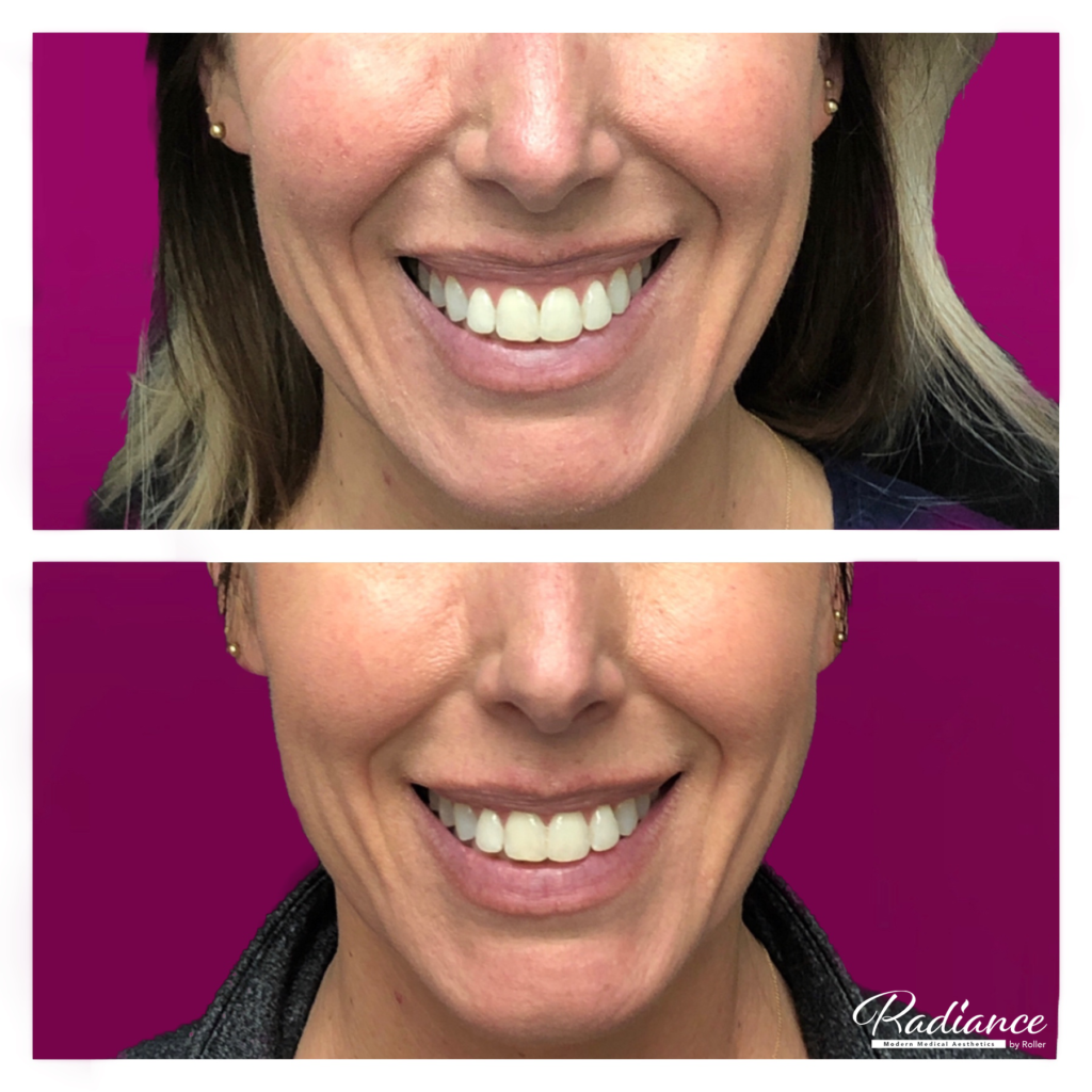 BOTOX Cosmetic Before & After Gallery - Patient 12532 - Image 1