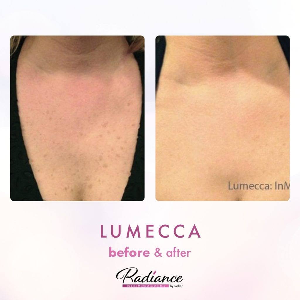 Lumecca Before & After Gallery - Patient 12682 - Image 1