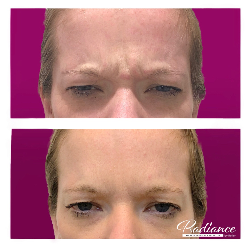 BOTOX Cosmetic Before & After Gallery - Patient 12526 - Image 1