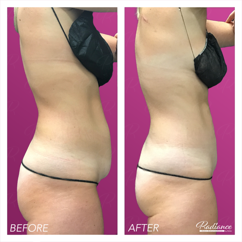BodyTite Before & After Gallery - Patient 12823 - Image 2