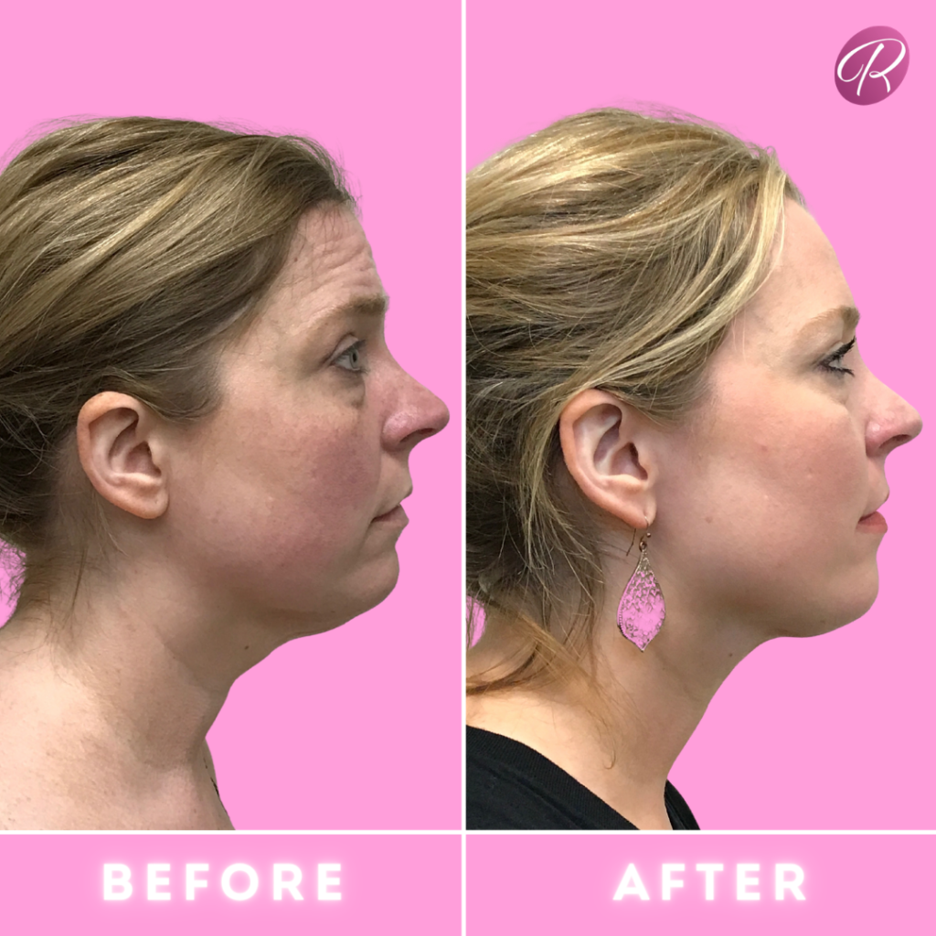 FaceTite Before & After Gallery - Patient 12871 - Image 2