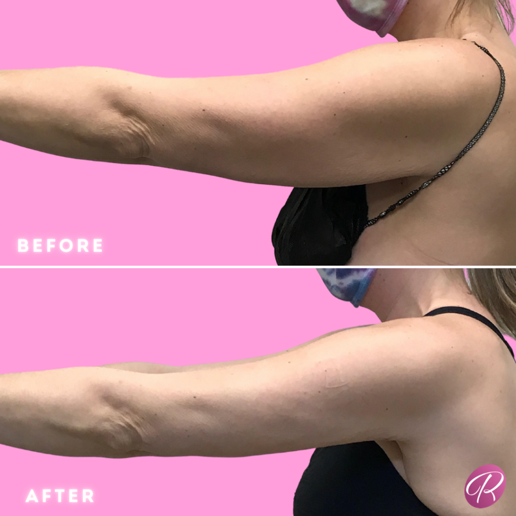 BodyTite Before & After Gallery - Patient 12820 - Image 3