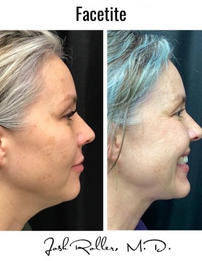 FaceTite Before & After Gallery - Patient 12866 - Image 1
