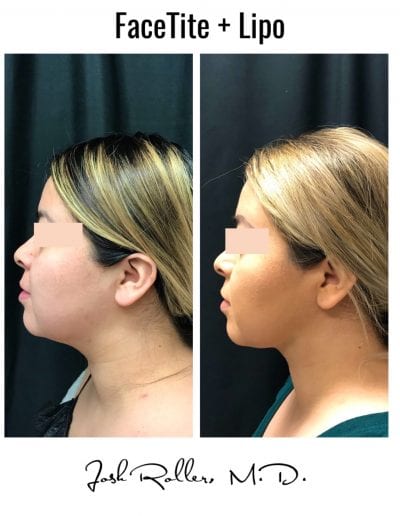 FaceTite Before & After Gallery - Patient 12863 - Image 2