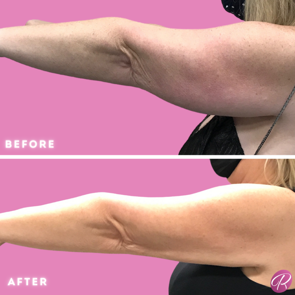 BodyTite Before & After Gallery - Patient 12817 - Image 2