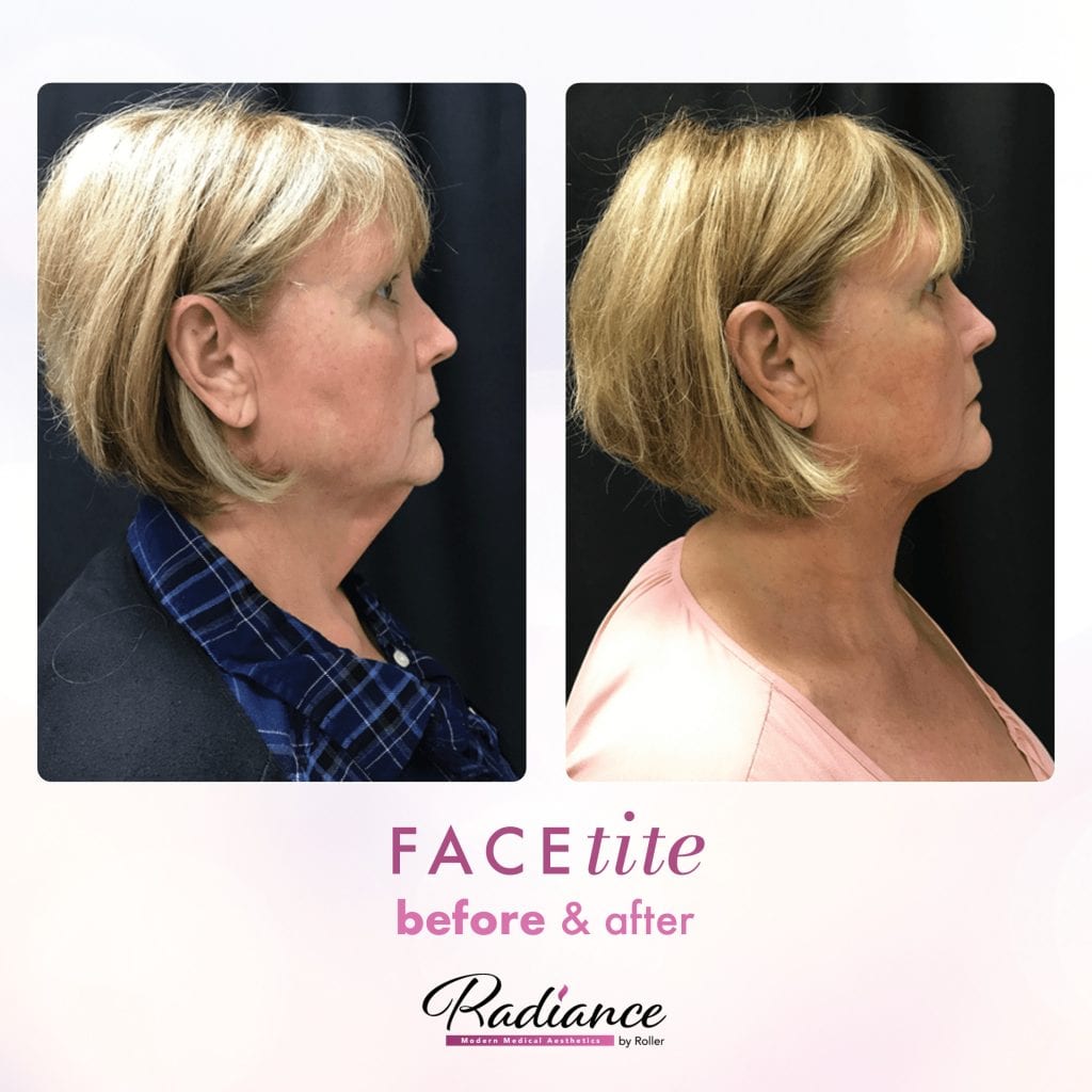 FaceTite Before & After Gallery - Patient 12852 - Image 1