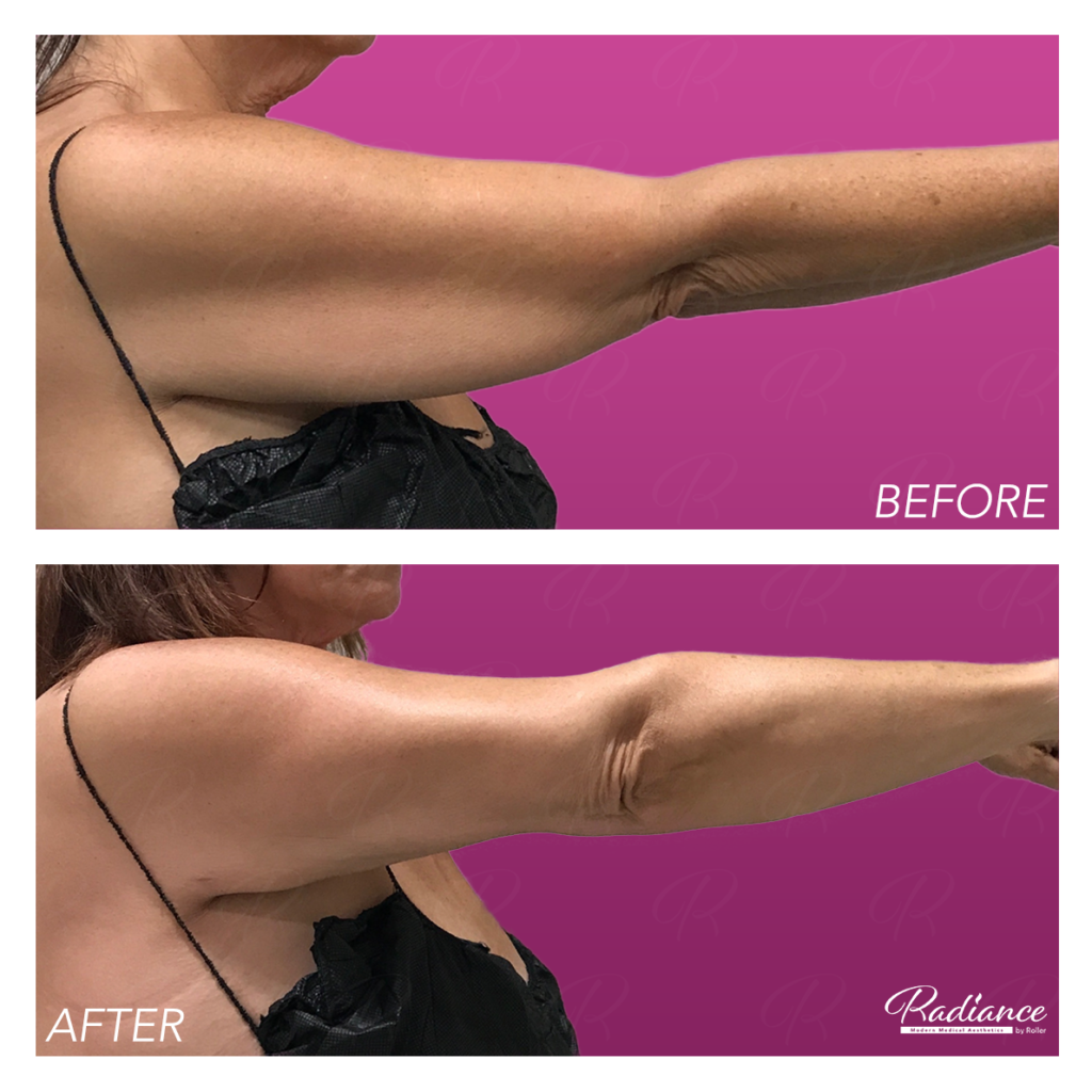 BodyTite Before & After Gallery - Patient 12814 - Image 2