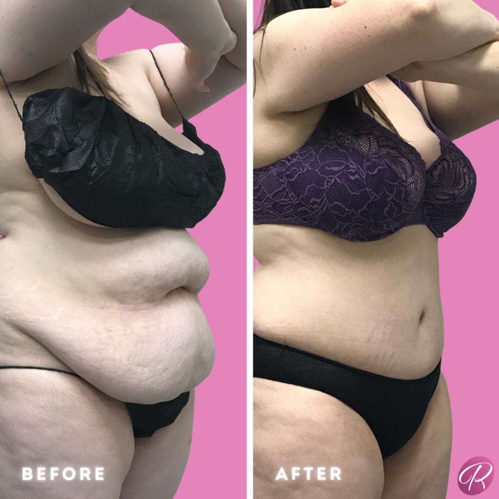 Tummy Tuck and Abdominoplasty Before & After Gallery - Patient 13153 - Image 2