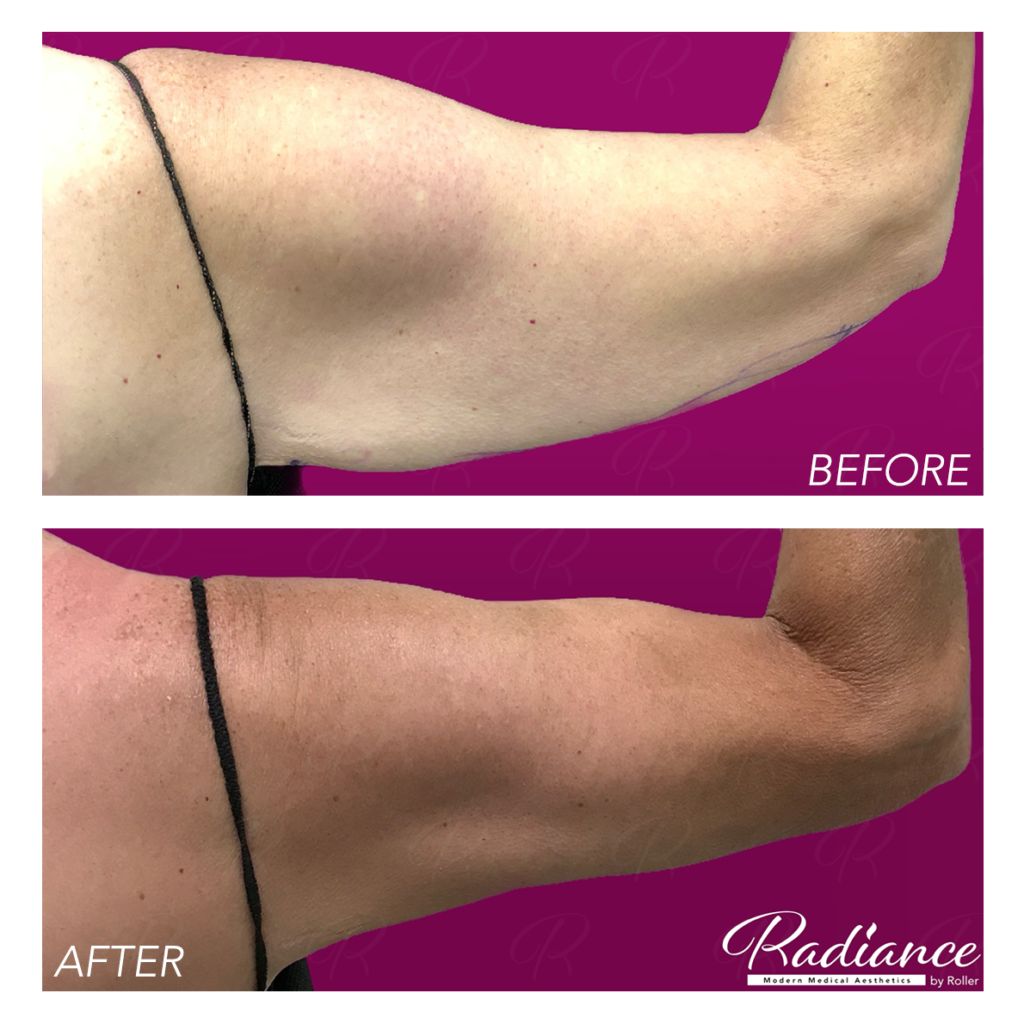 BodyTite Before & After Gallery - Patient 12811 - Image 2
