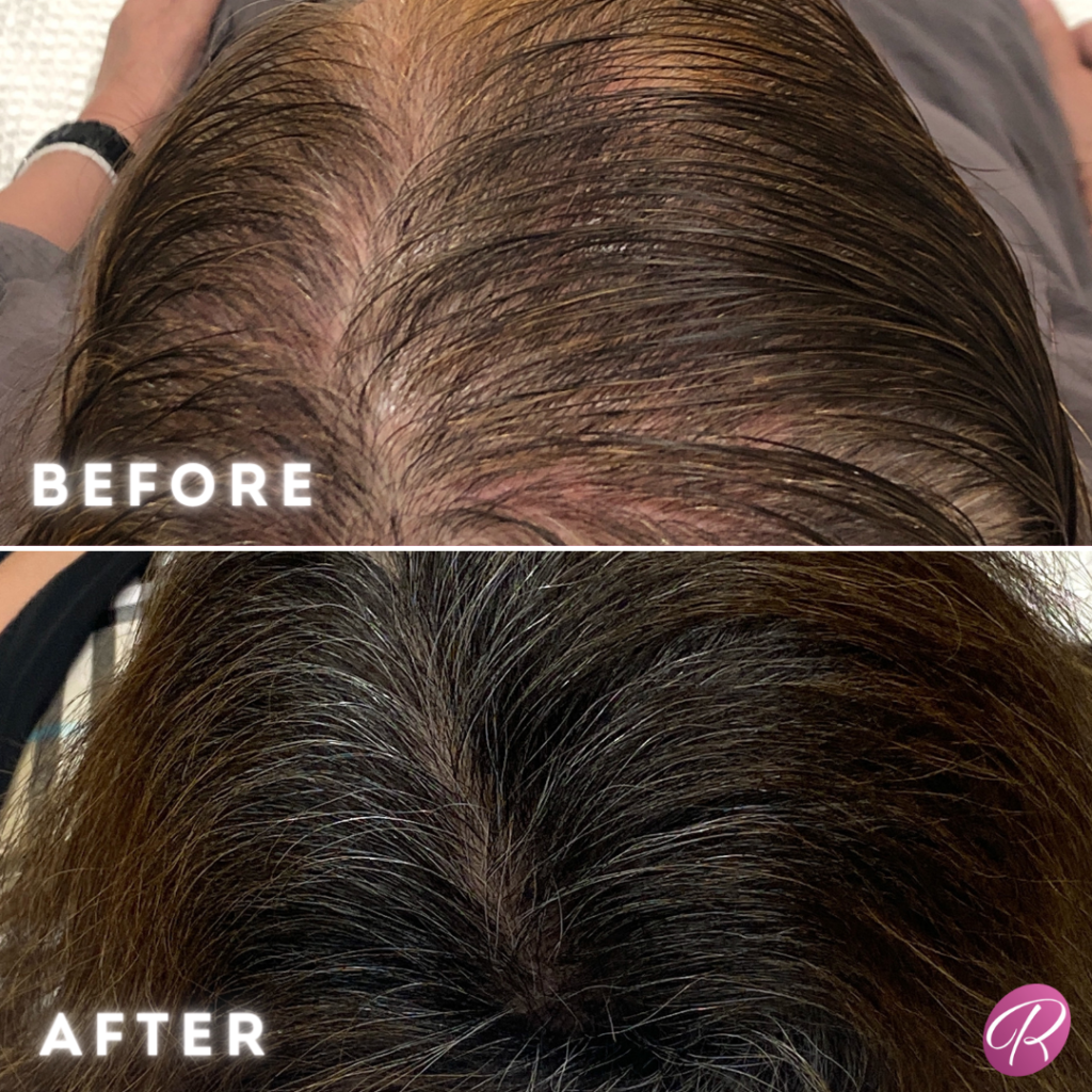 Keralase Before & After Gallery - Patient 13162 - Image 1