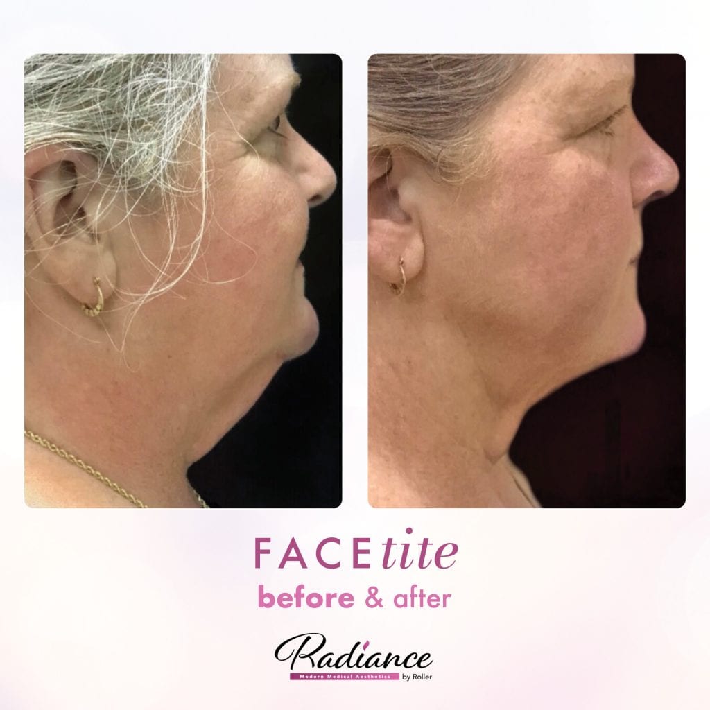 FaceTite Before & After Gallery - Patient 12842 - Image 1