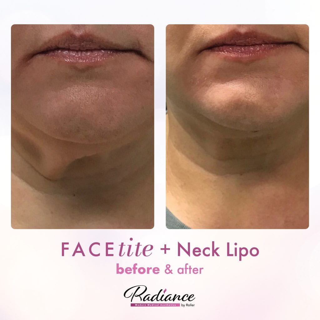 FaceTite Before & After Gallery - Patient 12840 - Image 1