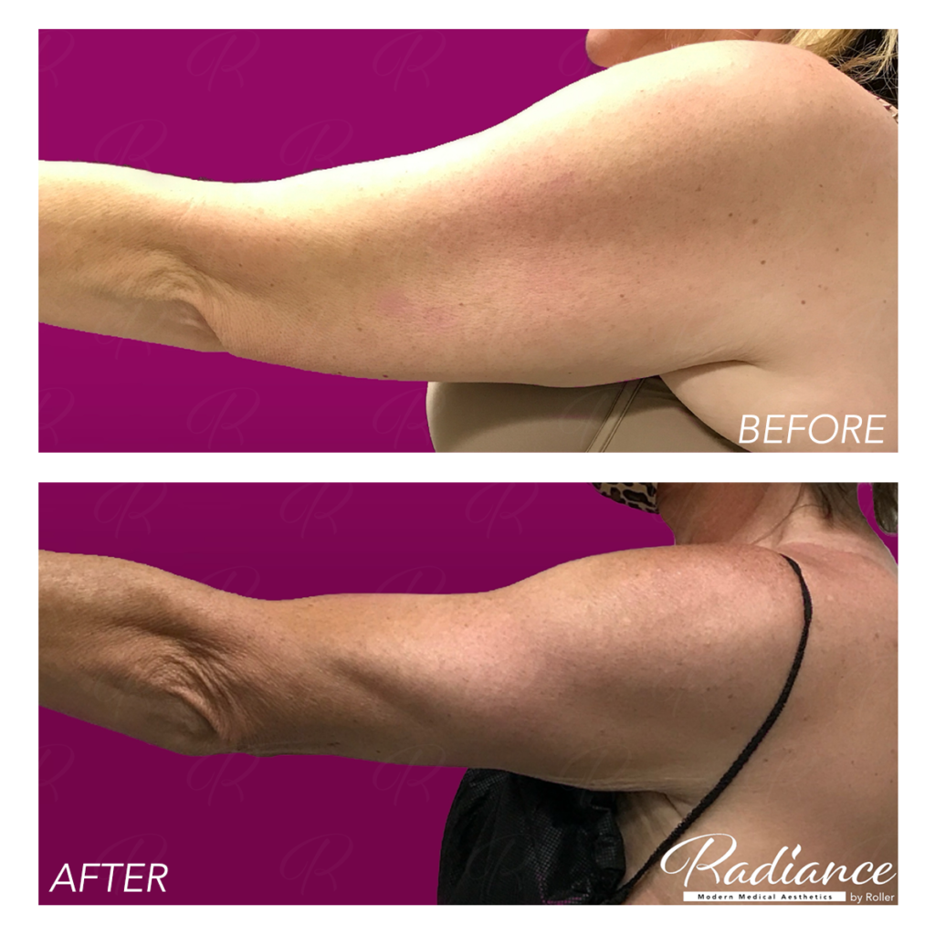 BodyTite Before & After Gallery - Patient 12811 - Image 3