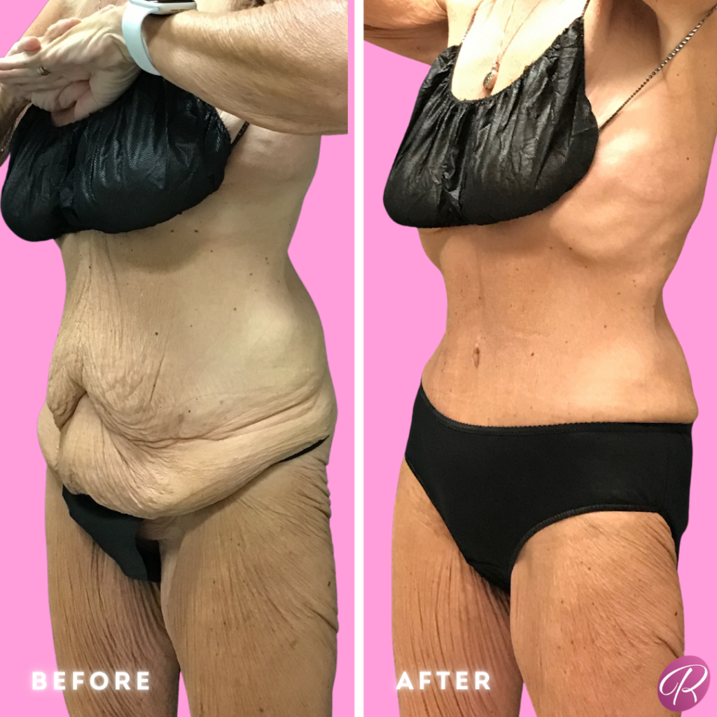 Tummy Tuck and Abdominoplasty Before & After Gallery - Patient 13148 - Image 2