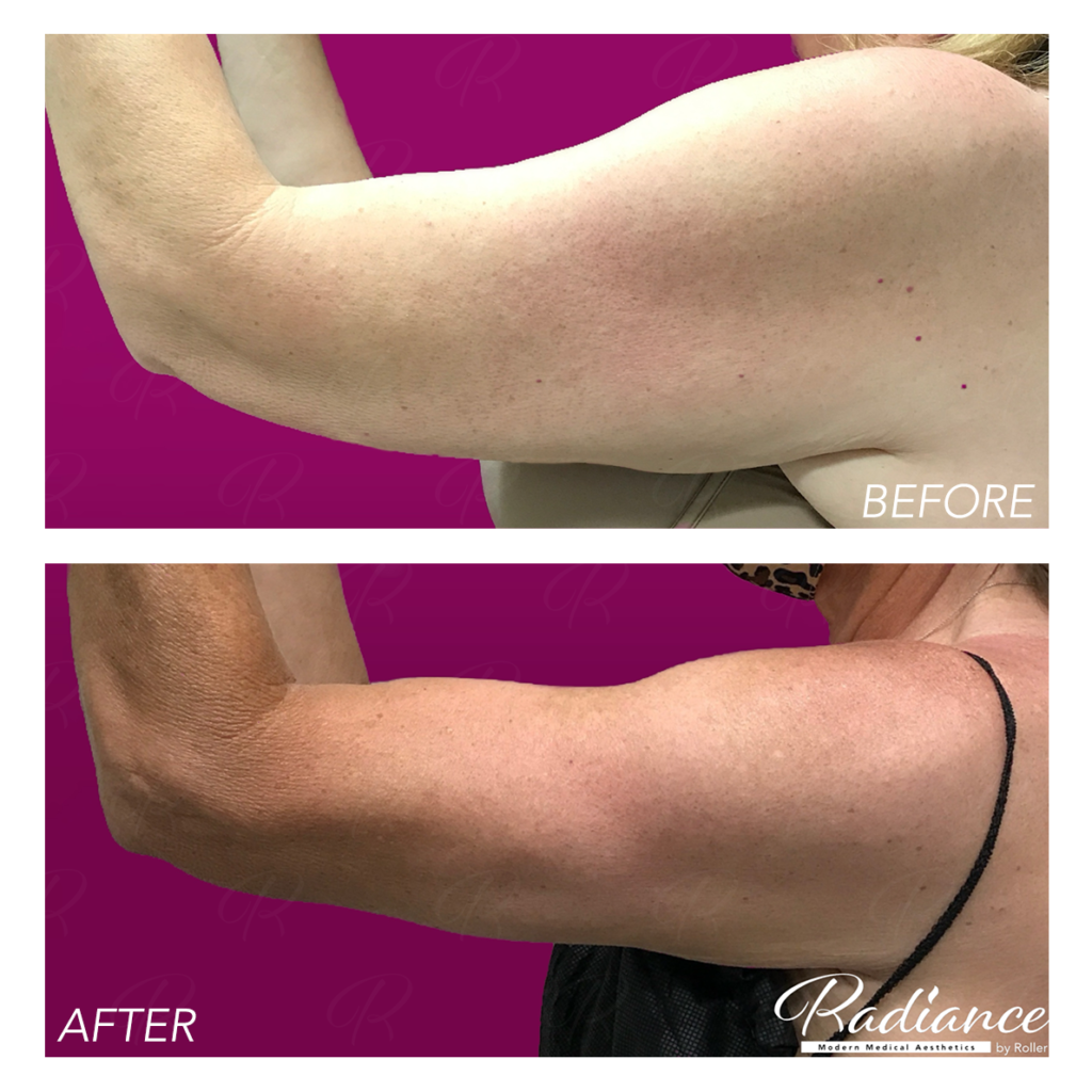 BodyTite Before & After Gallery - Patient 12811 - Image 5