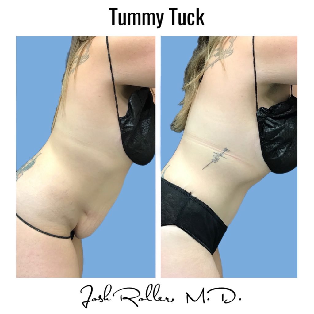 Tummy Tuck and Abdominoplasty Before & After Gallery - Patient 13139 - Image 6