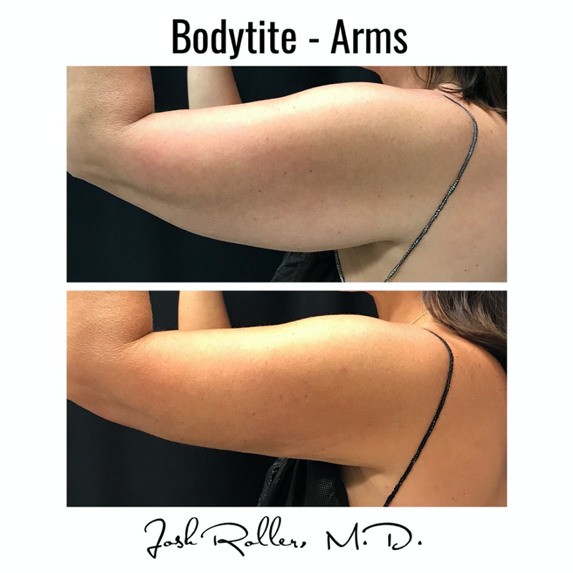 BodyTite Before & After Gallery - Patient 12808 - Image 4