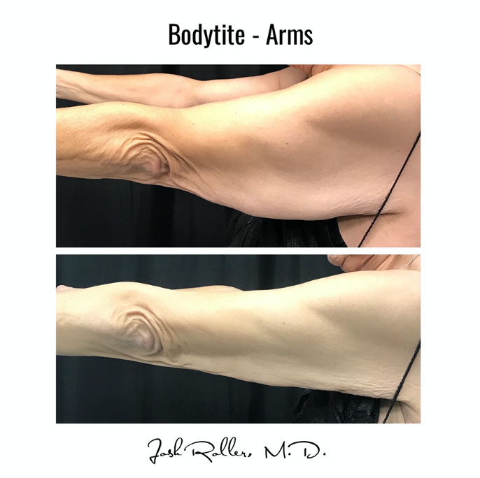 BodyTite Before & After Gallery - Patient 12805 - Image 2