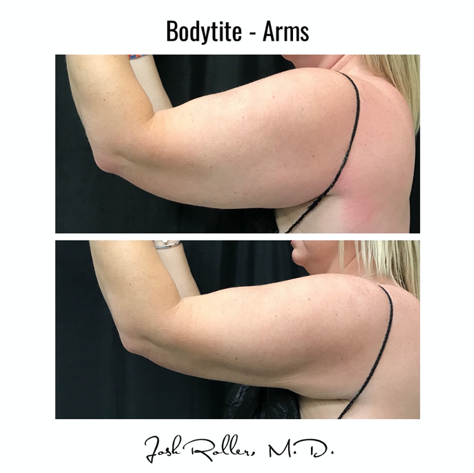 BodyTite Before & After Gallery - Patient 12802 - Image 2
