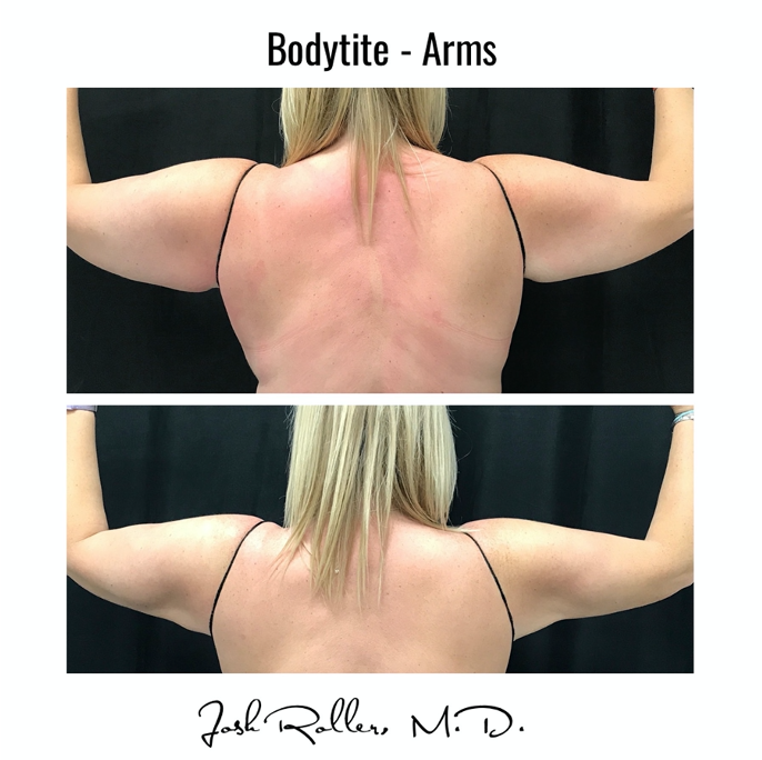 BodyTite Before & After Gallery - Patient 12802 - Image 3