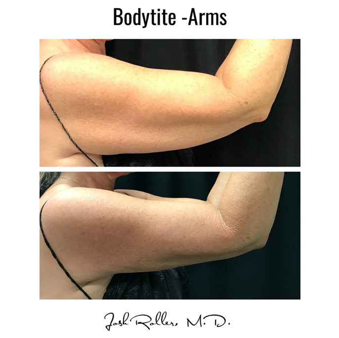 BodyTite Before & After Gallery - Patient 12797 - Image 1