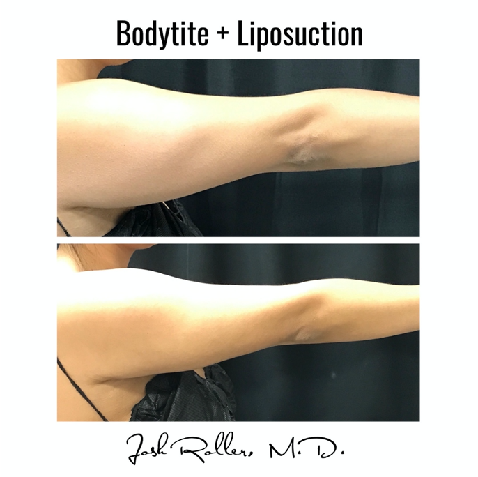 BodyTite Before & After Gallery - Patient 12788 - Image 1