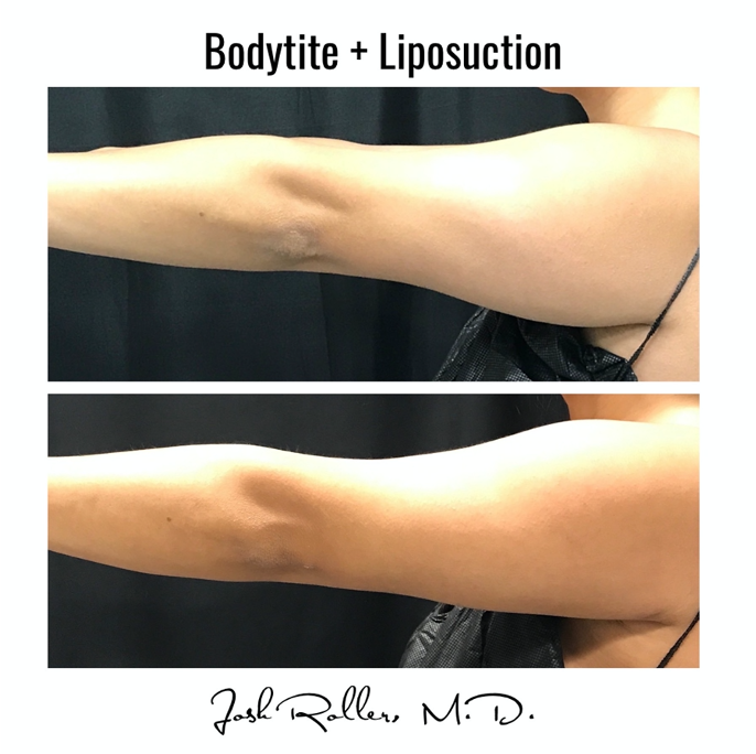 BodyTite Before & After Gallery - Patient 12788 - Image 2