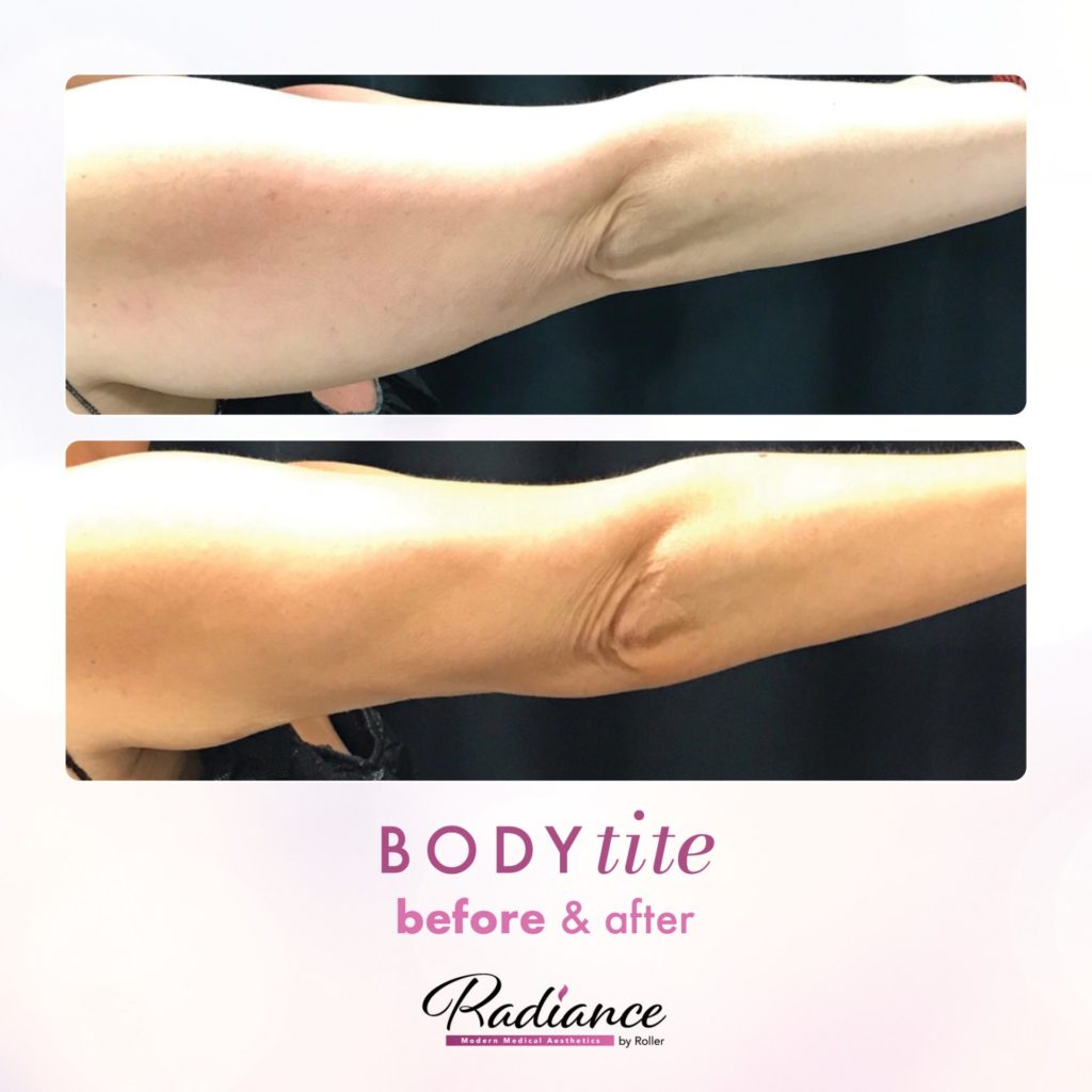 BodyTite Before & After Gallery - Patient 12774 - Image 3