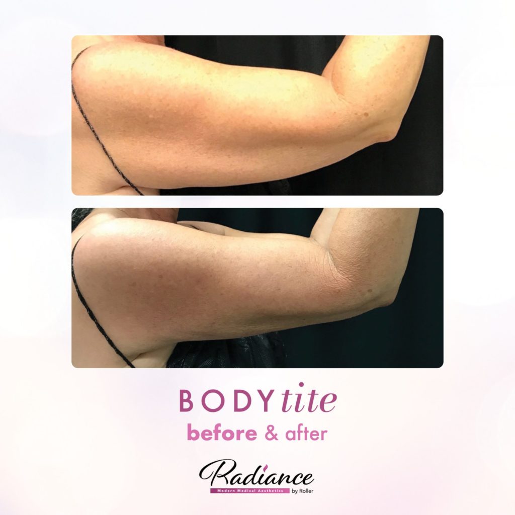 BodyTite Before & After Gallery - Patient 12759 - Image 2