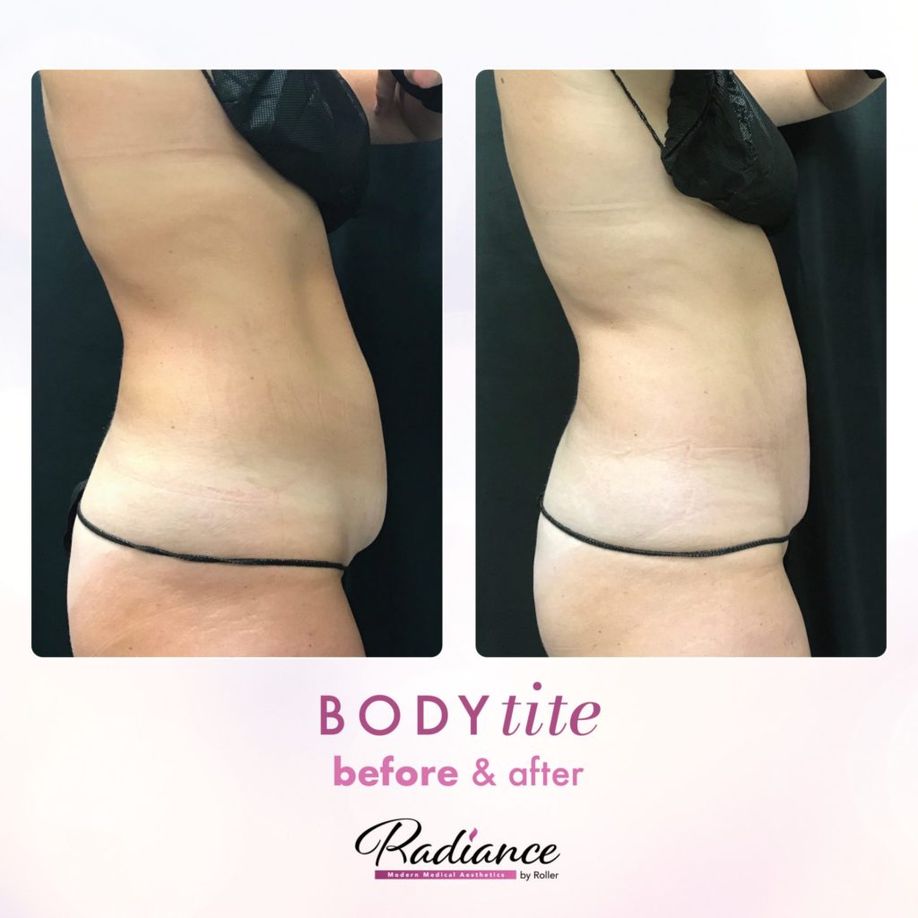 BodyTite Before & After Gallery - Patient 12754 - Image 2
