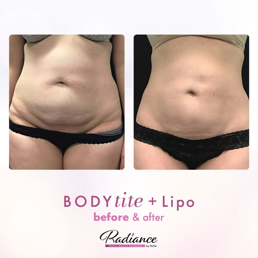 BodyTite Before & After Gallery - Patient 12751 - Image 2