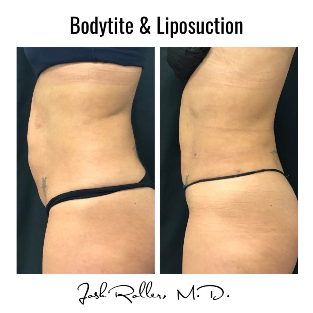 BodyTite Before & After Gallery - Patient 12746 - Image 2