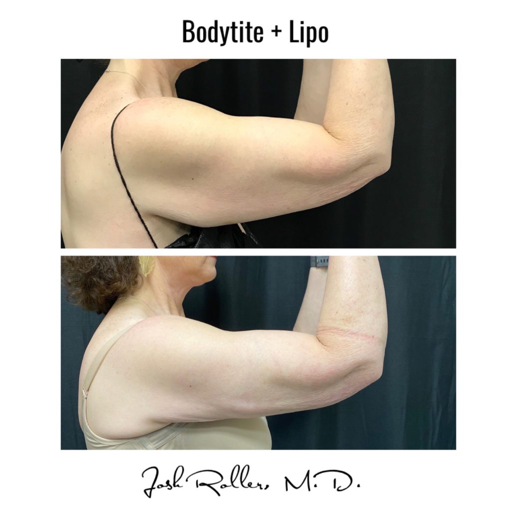 BodyTite Before & After Gallery - Patient 12743 - Image 4