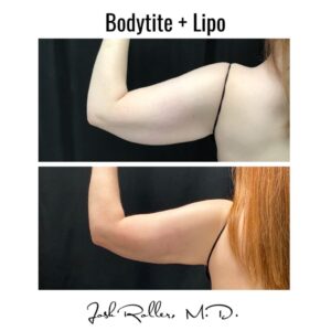 86643515