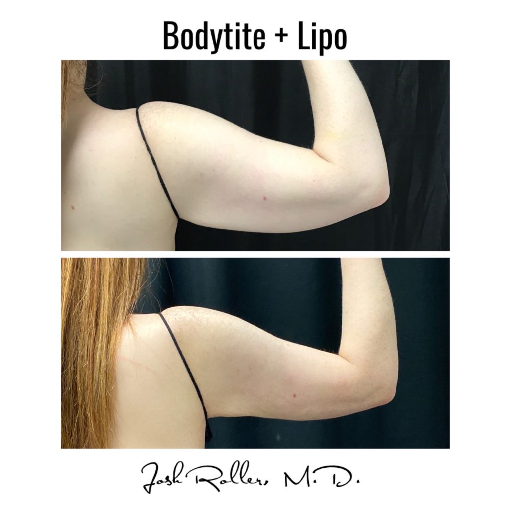 BodyTite Before & After Gallery - Patient 12740 - Image 2
