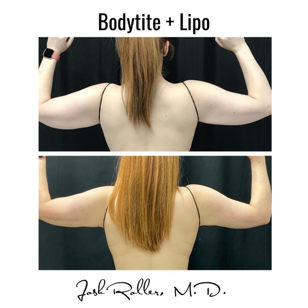 BodyTite Before & After Gallery - Patient 12740 - Image 3