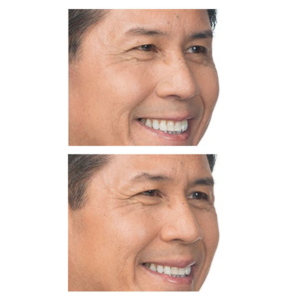 BOTOX Cosmetic Before & After Gallery - Patient 12524 - Image 1