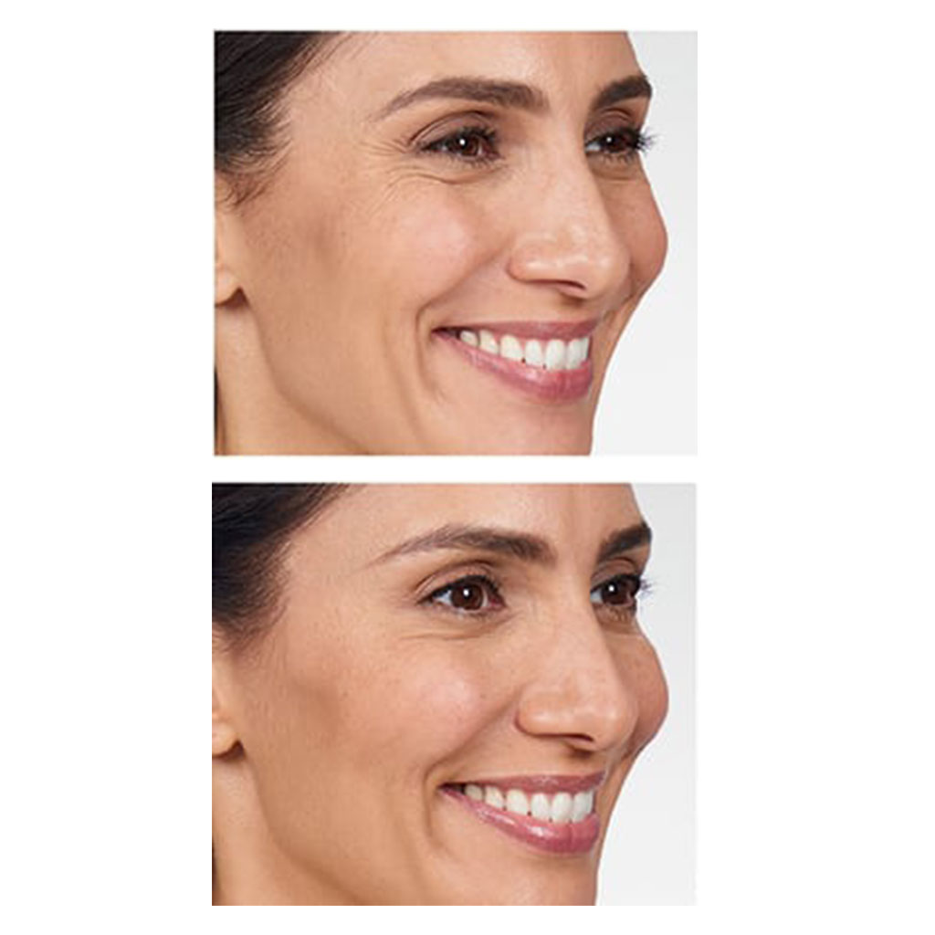 BOTOX Cosmetic Before & After Gallery - Patient 12522 - Image 1
