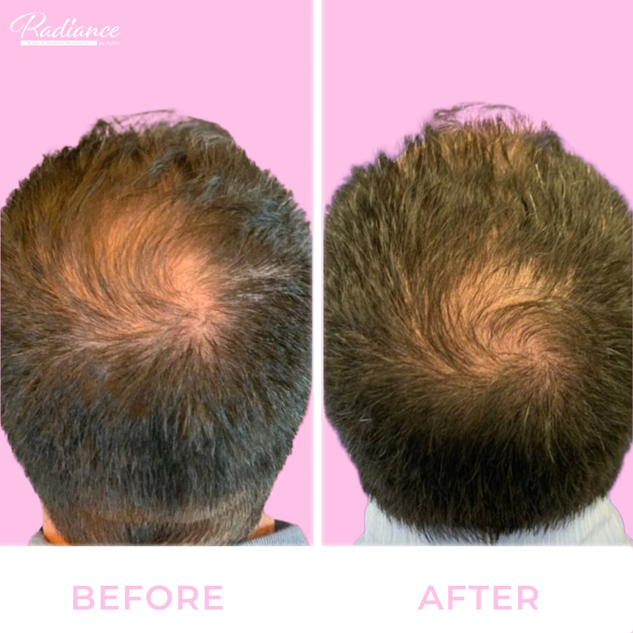 Keralase Before & After Gallery - Patient 13164 - Image 1