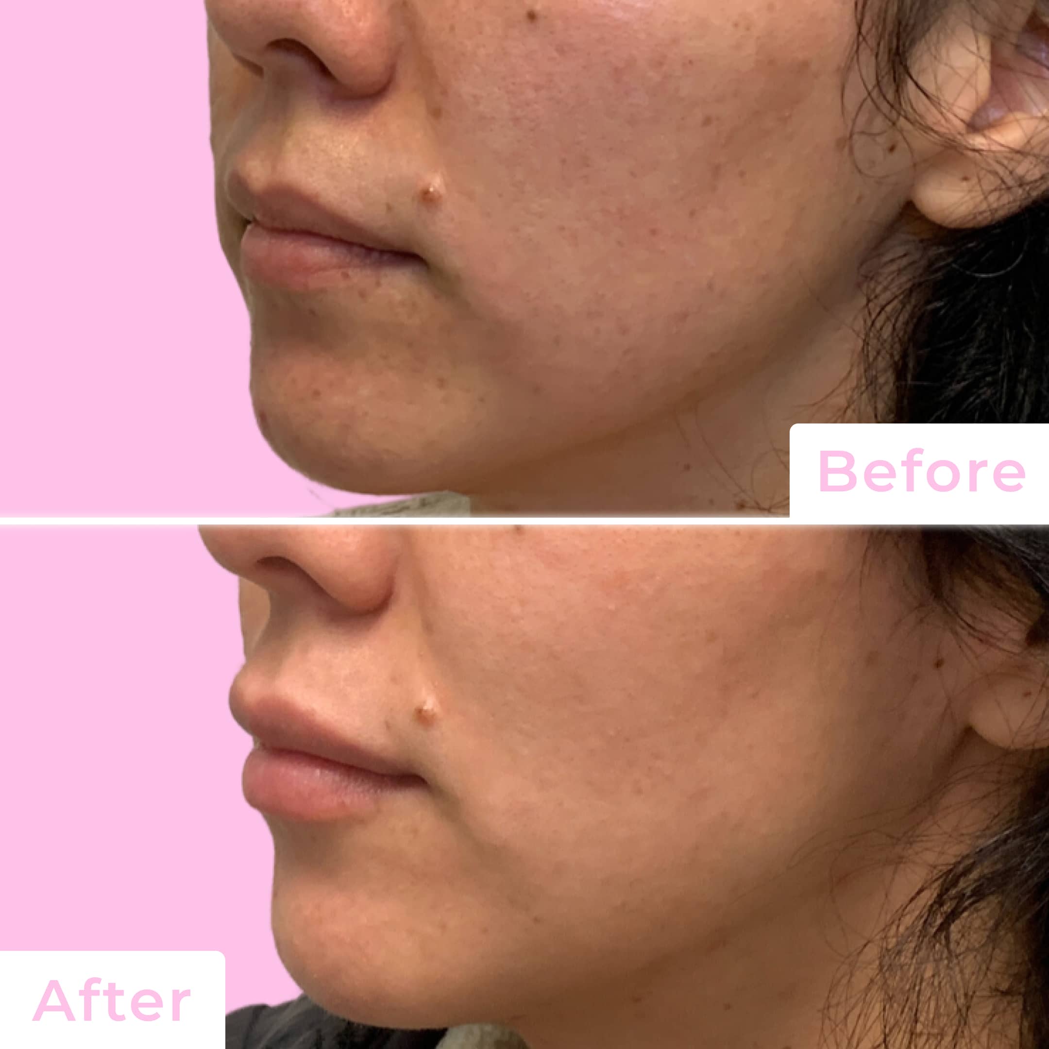 Fillers Before & After Gallery - Patient 12481 - Image 3